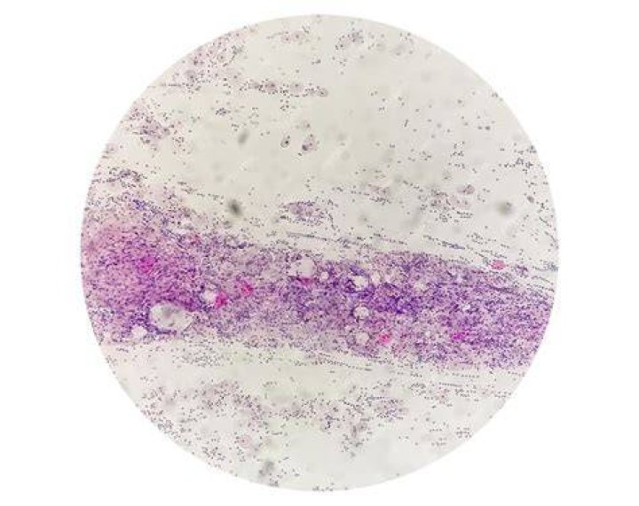 What does mild inflammation mean on a Pap smear?